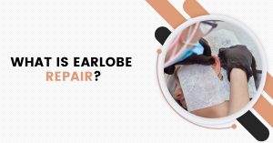 Read more about the article Earlobe Repair – Causes of Earlobe, Risk Factors, Cost, and Procedure