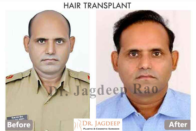 Best Hair Transplant in Jaipur - Dr. Jagdeep Rao