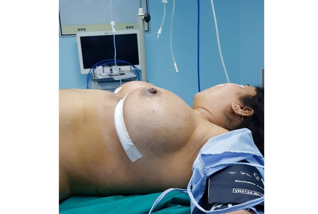 breast augmentation