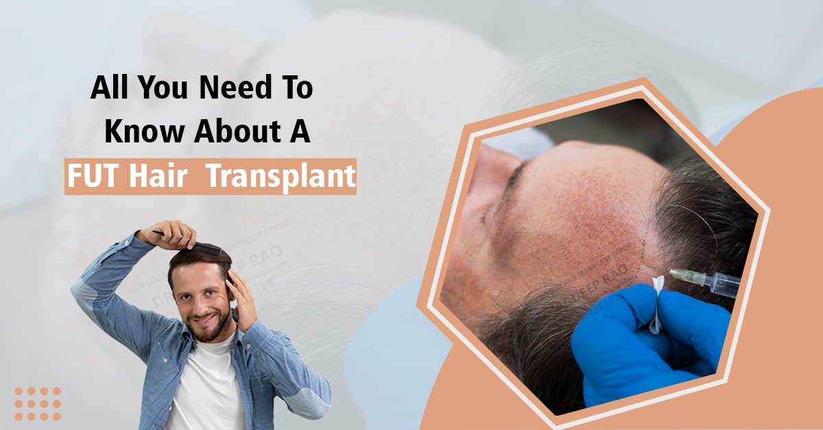 All You Need to Know About a FUT Hair Transplant