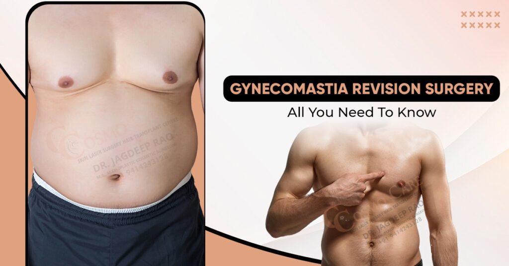 Gynecomastia Revision Surgery