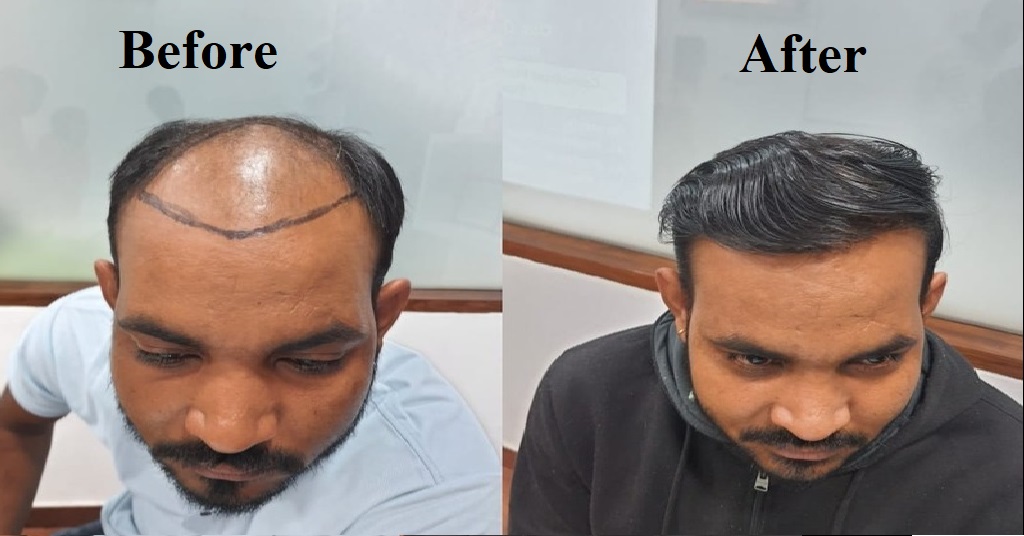 Best Hair Specialist in Jaipur