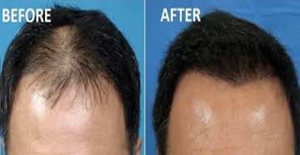 Hair Fall Treatment in Jaipur