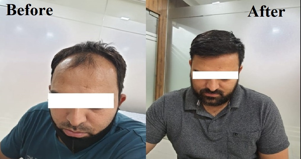 Hair Transplant Clinic in Jaipur
