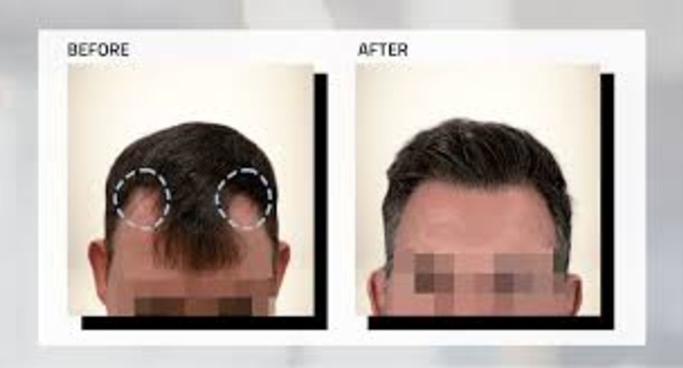 Hair Transplant Clinic in Jaipur