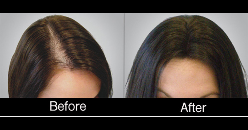 PRP Treatment in Jaipur