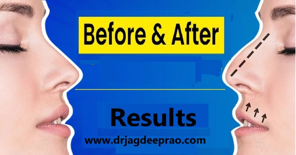 Rhinoplasty-Clinic-in-Jaipur