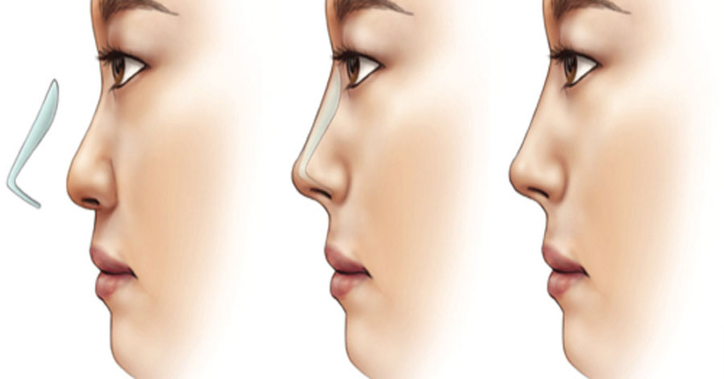 Nose Reshaping Doctors in Jaipur