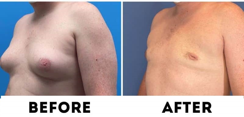gynecomastia-surgery