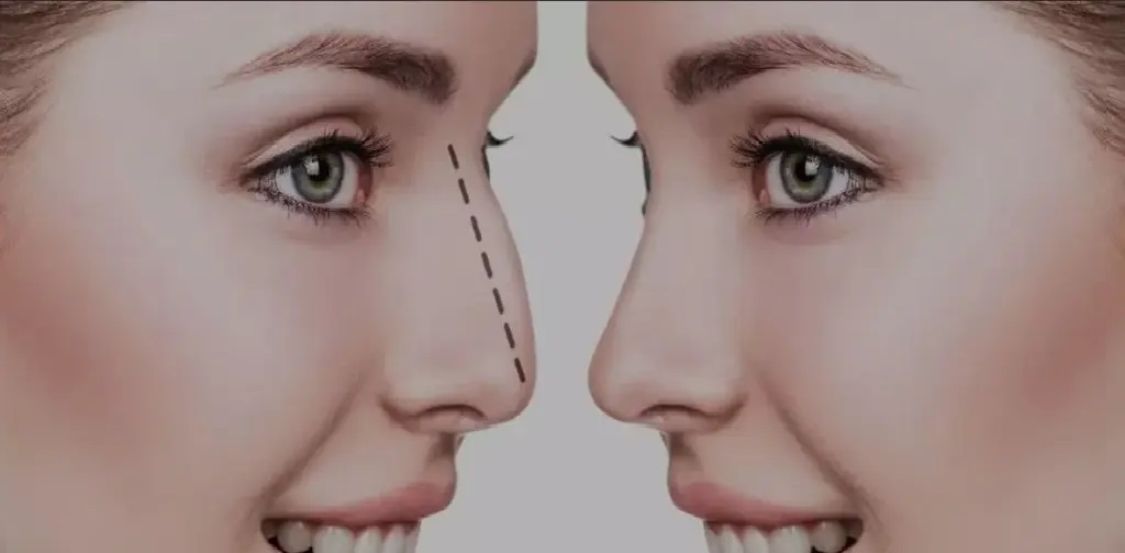 Rhinoplasty
