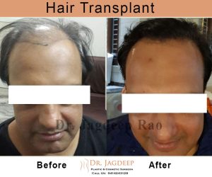 Best hair transplant in Jaipur | cosmo care