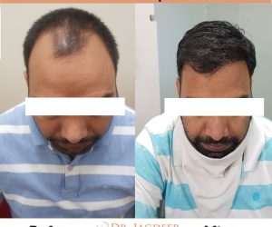 best hair transplant clinic in Jaipur