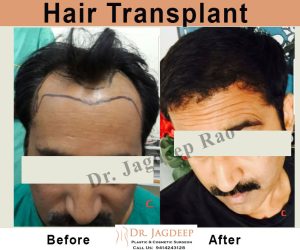 hair transplant cost in Jaipur