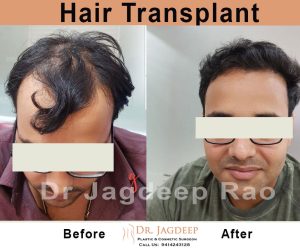 hair transplant doctor in Jaipur | Dr. Jagdeep Rao