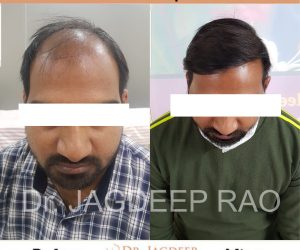 hair transplant hospital in Jaipur