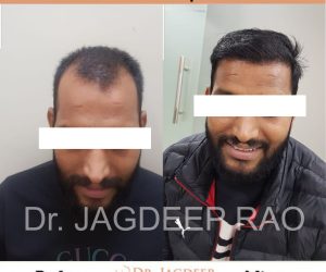 best hair transplant in Jaipur photo