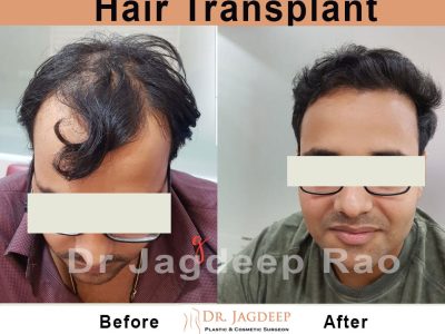best Hair transplant in Jaipur