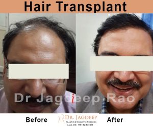 Hair transplantation in Jaipur