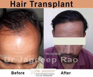 Best Hair transplant clinic in Jaipur
