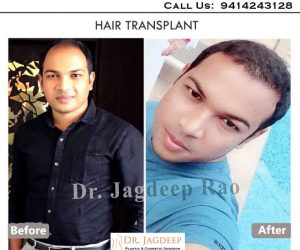 hair transplant treatment in jaipur