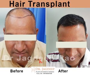 Hair transplant in Jaipur