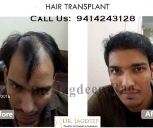 best hair transplant in Jaipur