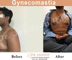 gynecomastia1