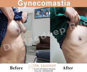 Gynecomastia Surgery in Jaipur